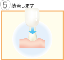 装着します